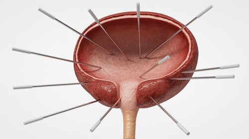 Understanding Your Gleason Score&##x3a; Why It Matters for Men with Prostate Cancer