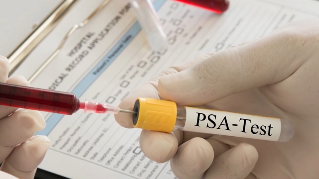 Just Diagnosed with Prostate Cancer? 10 Essential Questions to Ask Before Any Treatment
