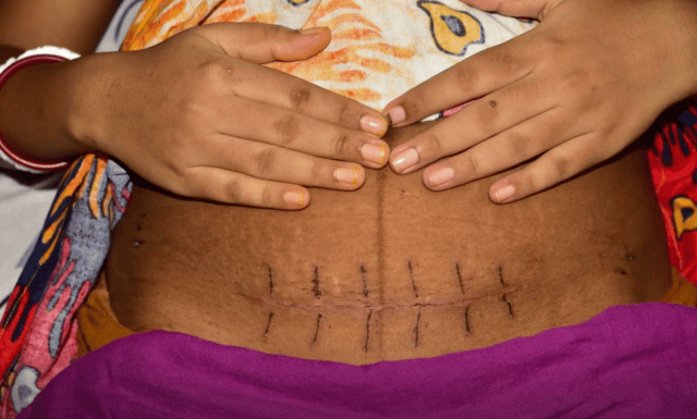 What the Doctors Don’t Tell You About C-Sections—And Why It Matters for Mothers and Their Babies.