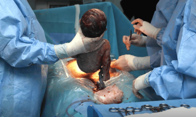 What the Doctors Don’t Tell You About C-Sections—And Why It Matters for Mothers and Their Babies.