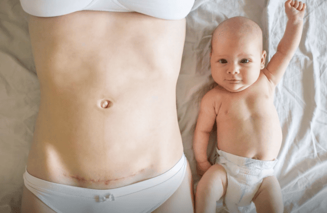 What the Doctors Don’t Tell You About C-Sections—And Why It Matters for Mothers and Their Babies.