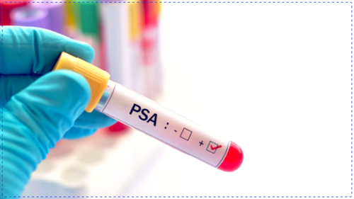 Control the Response, Not the Number&##x3a; A Smarter Way to Think About PSA and Stress