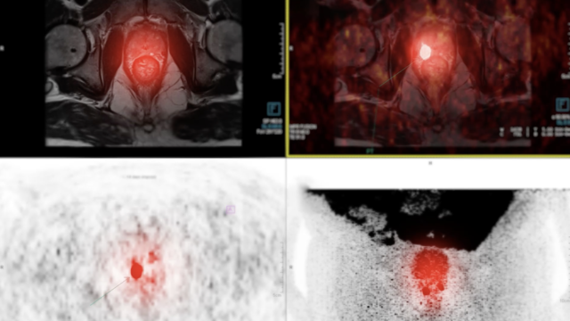 The Power of Precision: How Proton Therapy Benefits Men with Prostate Cancer