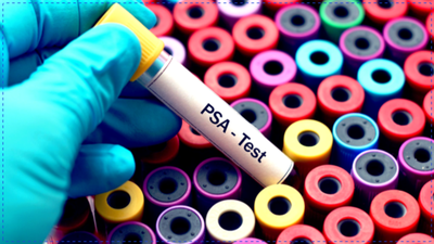PSA Test Controversy: Does a High PSA Really Mean You Have Prostate Cancer?